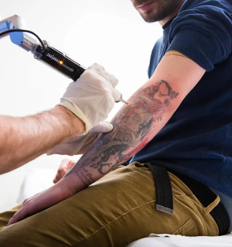 Tattoo Removal