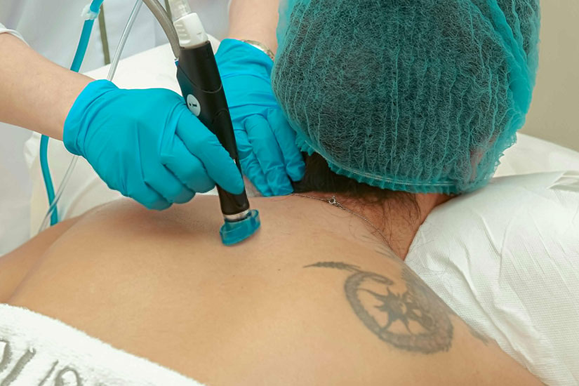 Tattoo Removal Perth